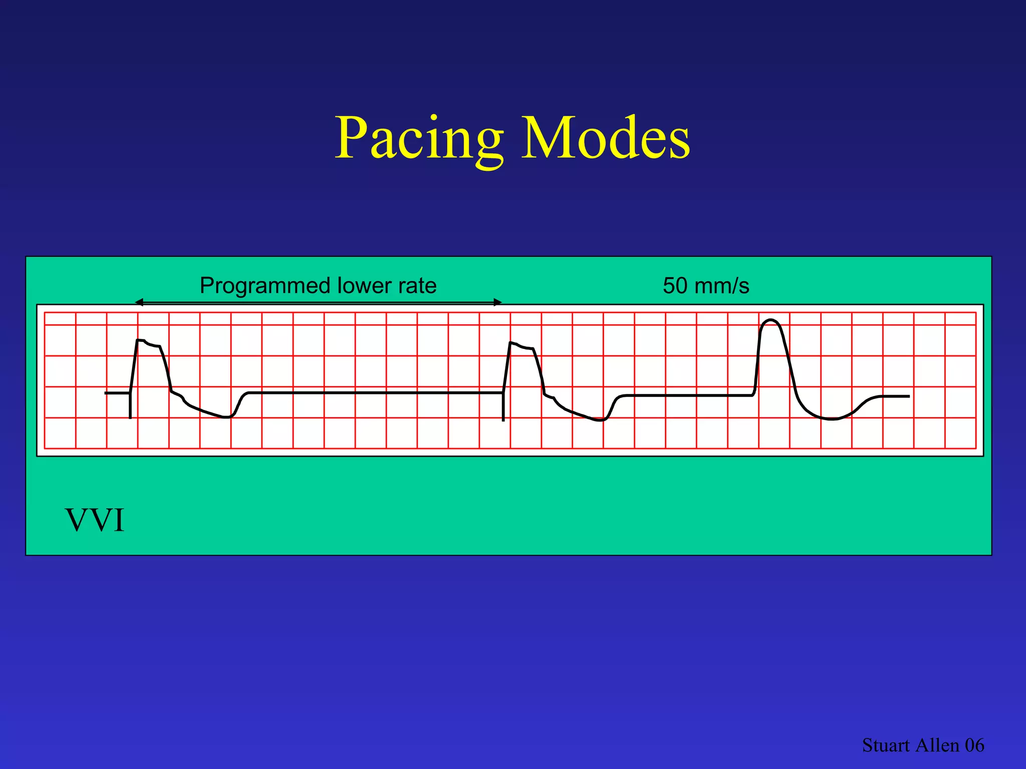 Stuart Allen 06 Pacing Modes Programmed lower rate 50 mm/s VVI 