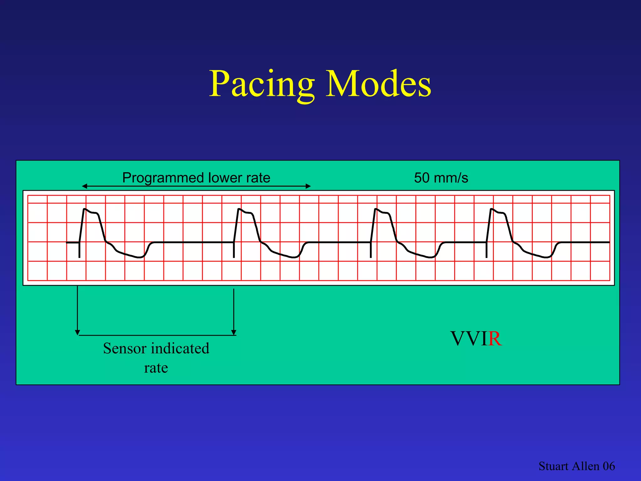 Pacing Modes Stuart Allen 06 VVI R Programmed lower rate 50 mm/s Sensor indicated rate 