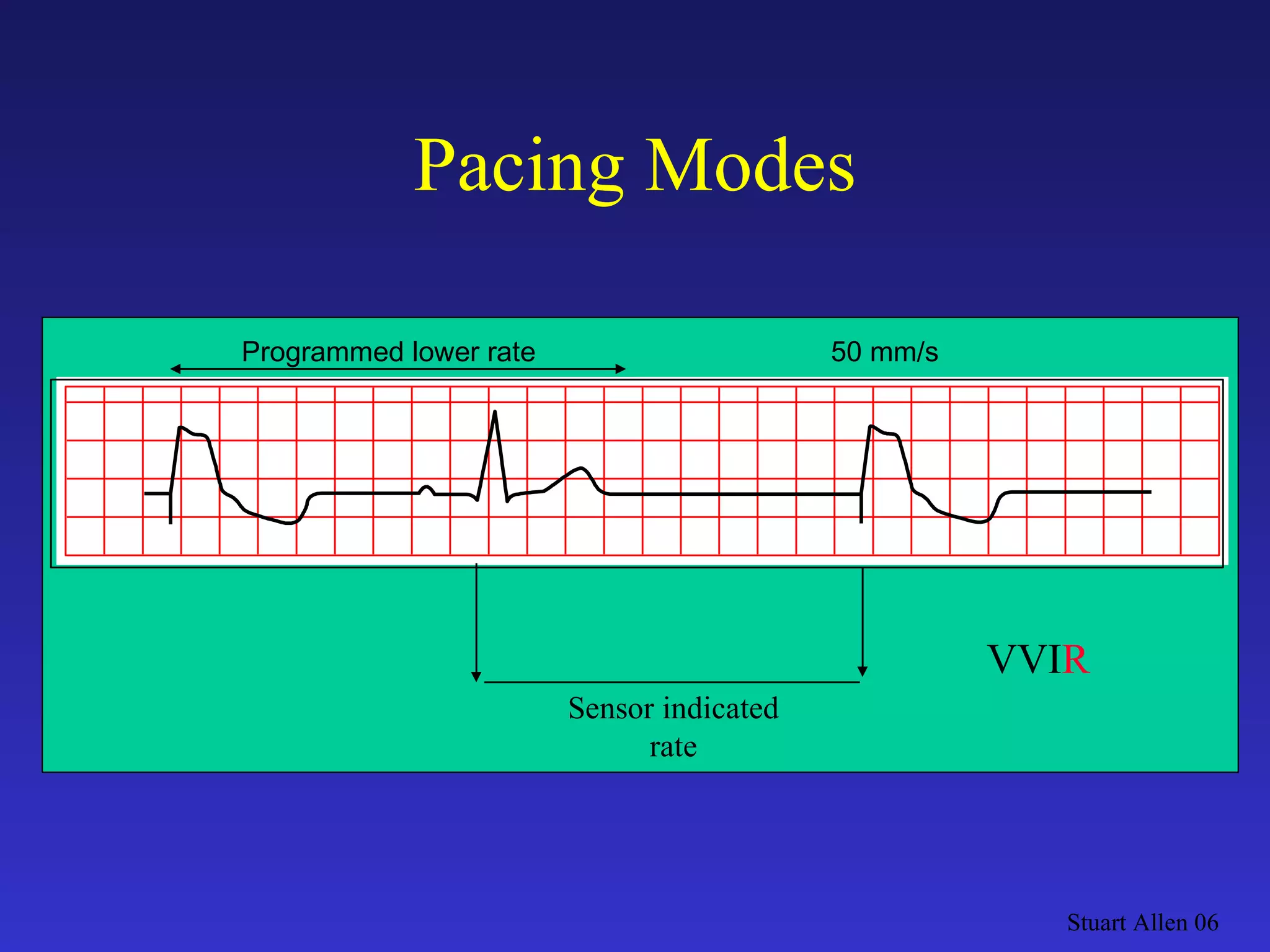 Pacing Modes Stuart Allen 06 Programmed lower rate 50 mm/s Sensor indicated rate VVI R 