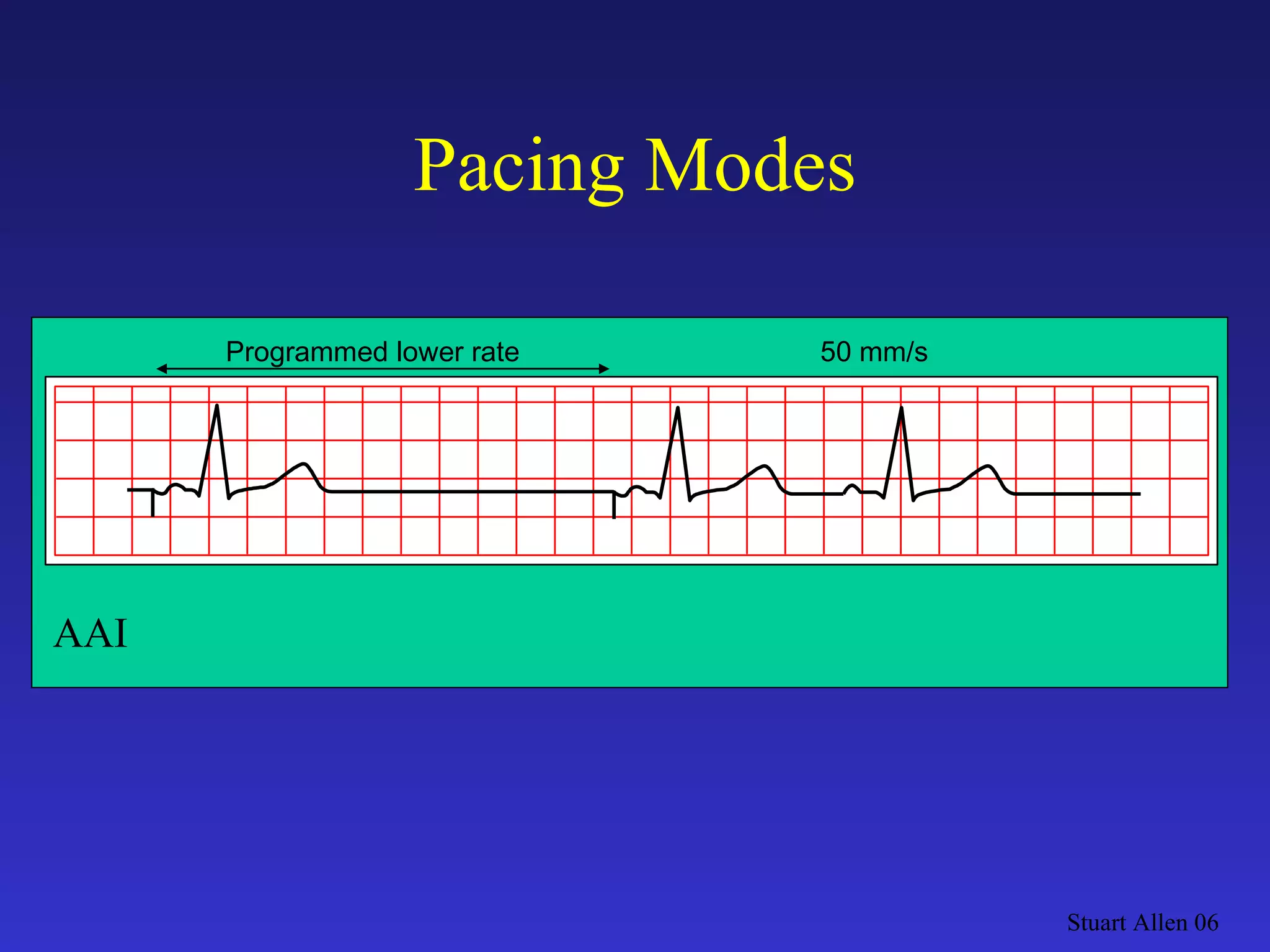 Pacing Modes Stuart Allen 06 Programmed lower rate 50 mm/s AAI 