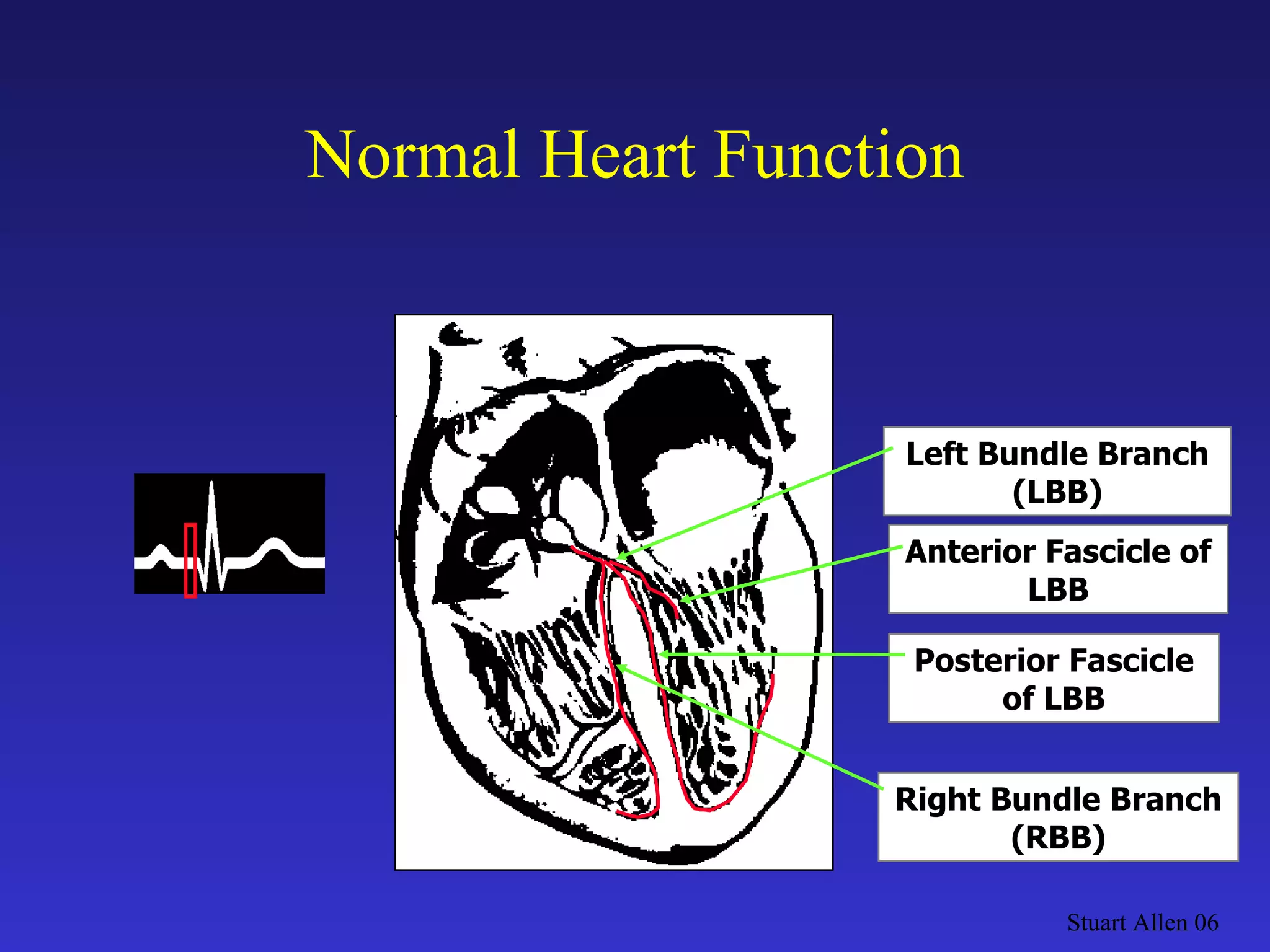 Normal Heart Function Stuart Allen 06 Left Bundle Branch (LBB) Anterior Fascicle of LBB Posterior Fascicle of LBB Right Bundle Branch (RBB) 
