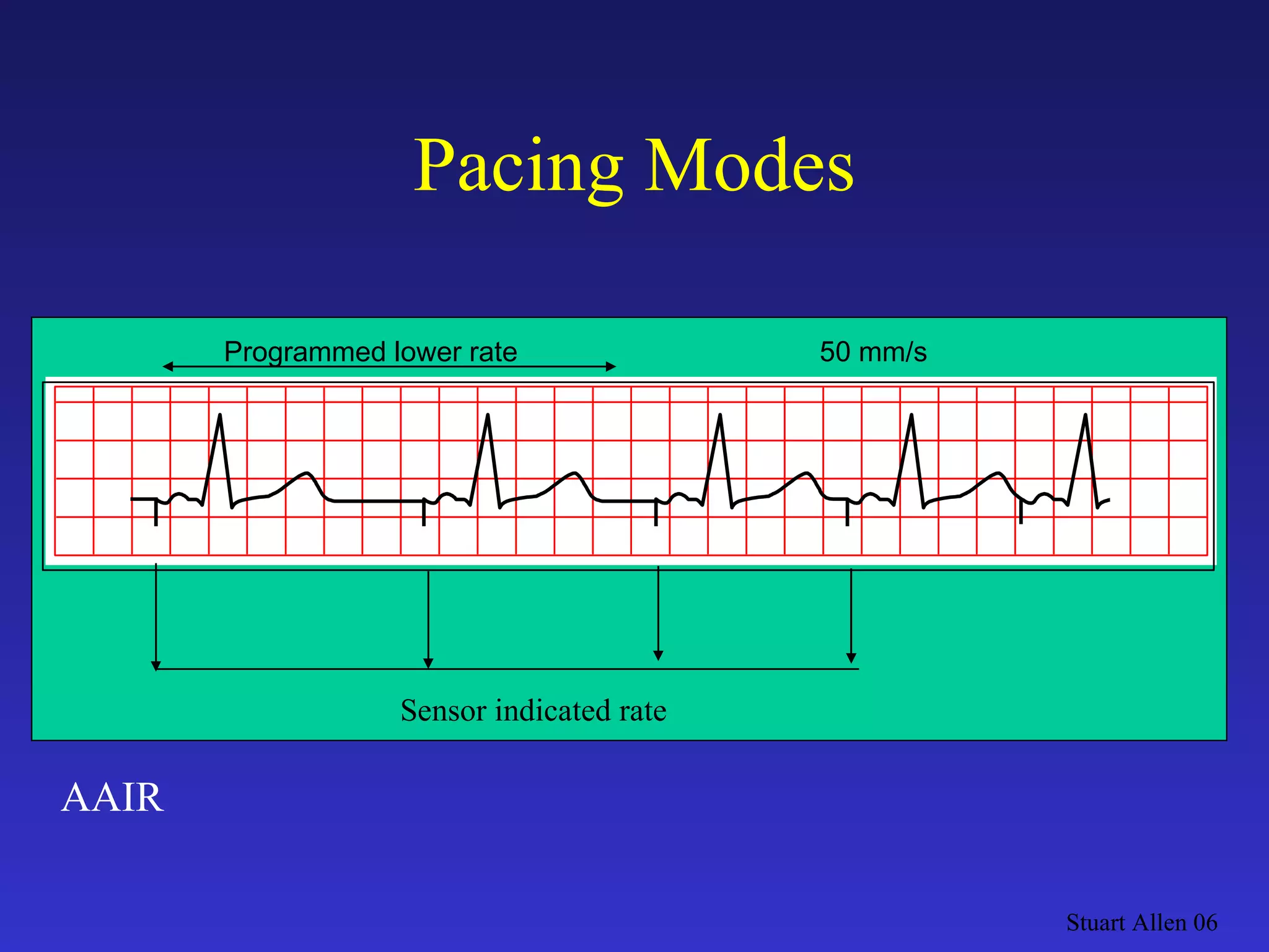 Pacing Modes Stuart Allen 06 Programmed lower rate 50 mm/s AAIR Sensor indicated rate 