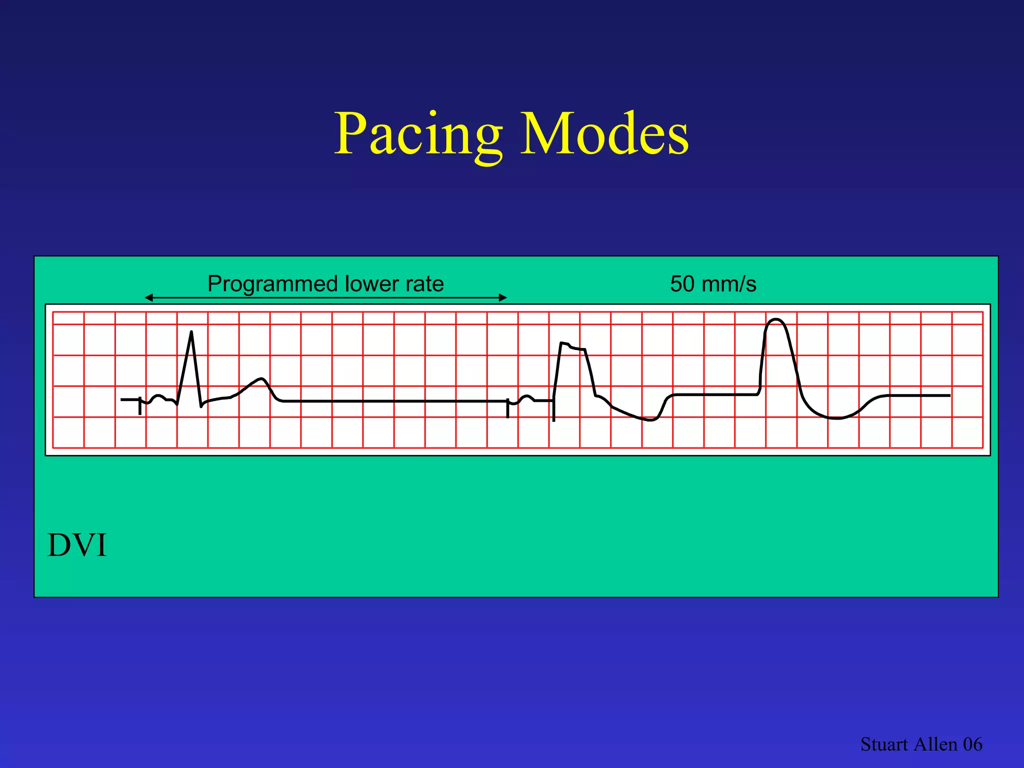 Pacing Modes Stuart Allen 06 Programmed lower rate 50 mm/s DVI 