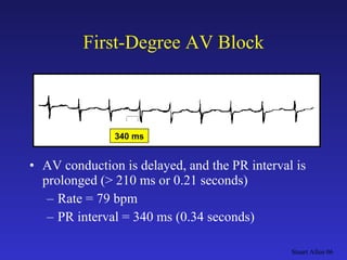 Pacemaker Overview | PPT