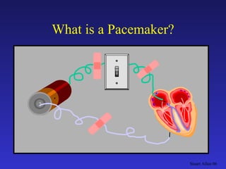 Pacemaker Overview | PPT