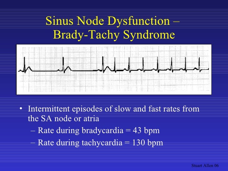 Tachy brady syndrome vs sick sinus syndrome taylorright