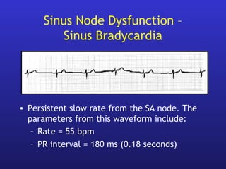 Sinus Node Dysfunction –
Sinus Bradycardia
• Persistent slow rate from the SA node. The
parameters from this waveform include:
– Rate = 55 bpm
– PR interval = 180 ms (0.18 seconds)
 