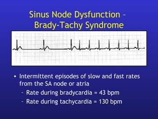 Sinus Node Dysfunction –
Brady-Tachy Syndrome
• Intermittent episodes of slow and fast rates
from the SA node or atria
– Rate during bradycardia = 43 bpm
– Rate during tachycardia = 130 bpm
 