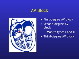 AV Block
• First-degree AV block
• Second-degree AV
block
– Mobitz types I and II
• Third-degree AV block
 