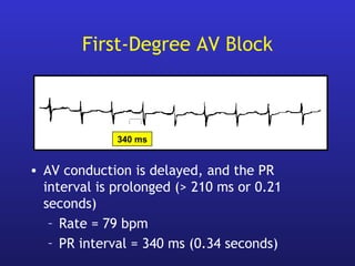 First-Degree AV Block
• AV conduction is delayed, and the PR
interval is prolonged (> 210 ms or 0.21
seconds)
– Rate = 79 bpm
– PR interval = 340 ms (0.34 seconds)
340 ms
 