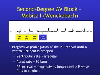 Second-Degree AV Block –
Mobitz I (Wenckebach)
• Progressive prolongation of the PR interval until a
ventricular beat is dropped
– Ventricular rate = irregular
– Atrial rate = 90 bpm
– PR interval = progressively longer until a P-wave
fails to conduct
200 360 400
ms ms ms
No
QRS
 