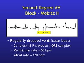 Second-Degree AV
Block – Mobitz II
• Regularly dropped ventricular beats
– 2:1 block (2 P waves to 1 QRS complex)
– Ventricular rate = 60 bpm
– Atrial rate = 120 bpm
P P QRS
 