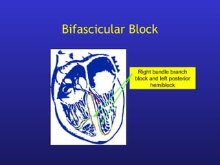Bifascicular Block
Right bundle branch
block and left posterior
hemiblock
 
