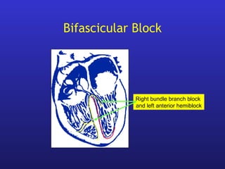 Bifascicular Block
Right bundle branch block
and left anterior hemiblock
 