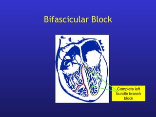 Bifascicular Block
Complete left
bundle branch
block
 