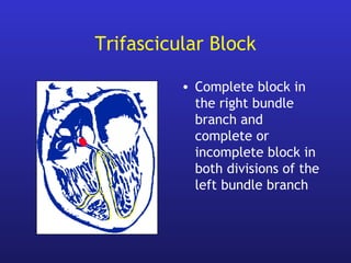 Trifascicular Block
• Complete block in
the right bundle
branch and
complete or
incomplete block in
both divisions of the
left bundle branch
 