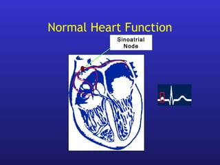 Sinoatrial
Node
Normal Heart Function
 