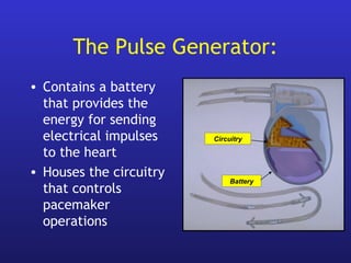 • Contains a battery
that provides the
energy for sending
electrical impulses
to the heart
• Houses the circuitry
that controls
pacemaker
operations
Circuitry
Battery
The Pulse Generator:
 
