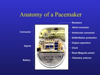 Battery
Connector
Hybrid
Telemetry antenna
Output capacitors
Reed (Magnet) switch
Clock
Defibrillation protection
Atrial connector
Ventricular connector
Resistors
Anatomy of a Pacemaker
 