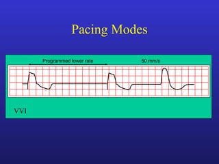 Programmed lower rate 50 mm/s
VVI
Pacing Modes
 