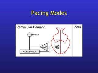 Output circuit
VVIR
AMP
Sensor
Ventricular Demand
Pacing Modes
 