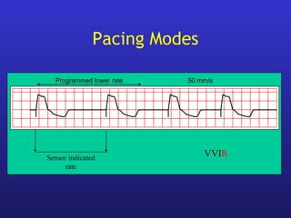 Programmed lower rate 50 mm/s
Sensor indicated
rate
VVIR
Pacing Modes
 
