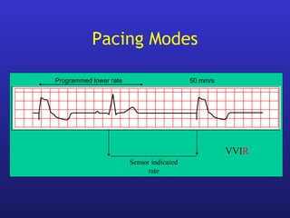 Programmed lower rate 50 mm/s
Sensor indicated
rate
VVIR
Pacing Modes
 