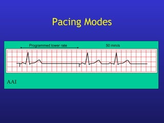 Programmed lower rate 50 mm/s
AAI
Pacing Modes
 