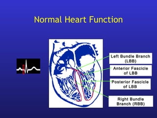 Normal Heart Function
Left Bundle Branch
(LBB)
Anterior Fascicle
of LBB
Posterior Fascicle
of LBB
Right Bundle
Branch (RBB)
 