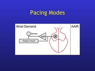 Output circuit
AAIR
AMP
Atrial Demand
Sensor
Pacing Modes
 