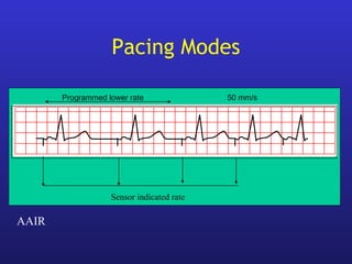 Programmed lower rate 50 mm/s
AAIR
Sensor indicated rate
Pacing Modes
 