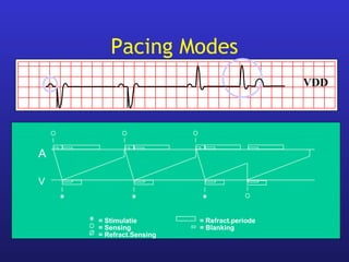 = Refract.Sensing
= Blanking
= Refract.periode= Stimulatie
= Sensing
V
A
Pacing Modes
VDD
 