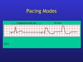 Programmed lower rate 50 mm/s
DVI
Pacing Modes
 