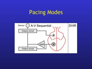 Output circuit
DVIR
AMP
A-V Sequential
Output circuit
Sensor
Pacing Modes
 