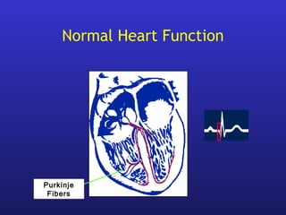 Normal Heart Function
Purkinje
Fibers
 