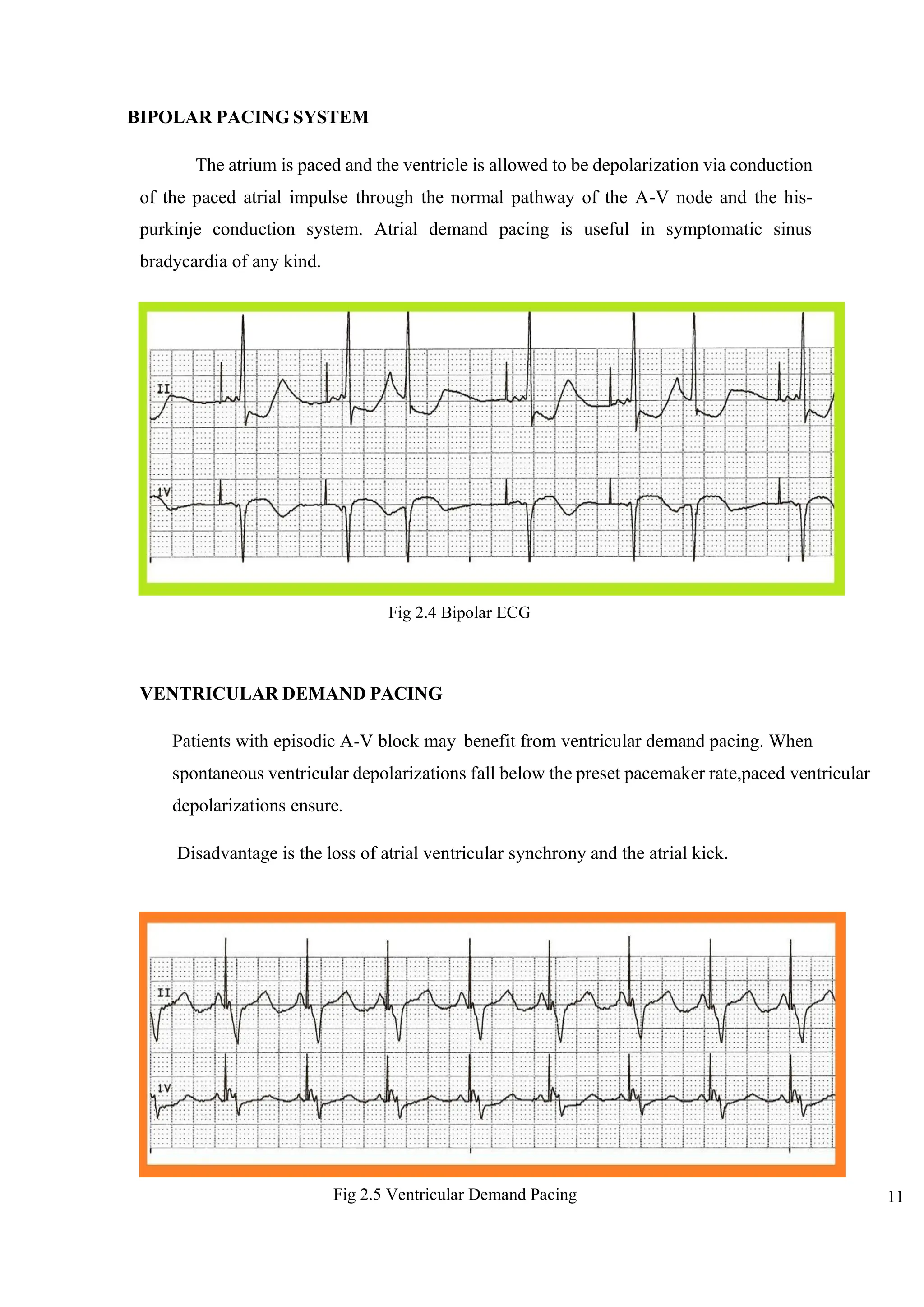 11
BIPOLAR PACING SYSTEM
The atrium is paced and the ventricle is allowed to be depolarization via conduction
of the paced atrial impulse through the normal pathway of the A-V node and the his-
purkinje conduction system. Atrial demand pacing is useful in symptomatic sinus
bradycardia of any kind.
VENTRICULAR DEMAND PACING
Patients with episodic A-V block may benefit from ventricular demand pacing. When
spontaneous ventricular depolarizations fall below the preset pacemaker rate,paced ventricular
depolarizations ensure.
Disadvantage is the loss of atrial ventricular synchrony and the atrial kick.
Fig 2.4 Bipolar ECG
Fig 2.5 Ventricular Demand Pacing
 