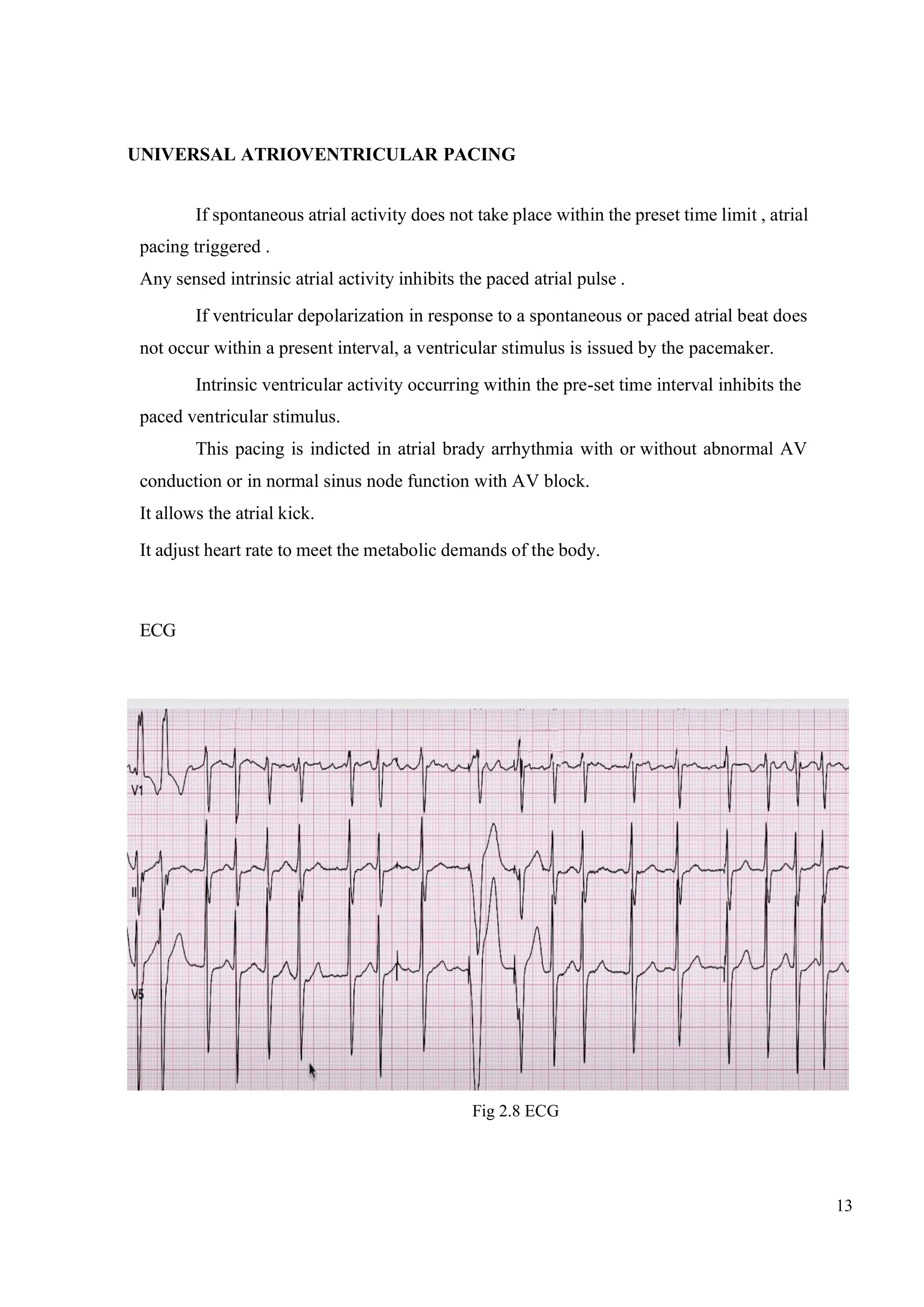 13
UNIVERSAL ATRIOVENTRICULAR PACING
If spontaneous atrial activity does not take place within the preset time limit , atrial
pacing triggered .
Any sensed intrinsic atrial activity inhibits the paced atrial pulse .
If ventricular depolarization in response to a spontaneous or paced atrial beat does
not occur within a present interval, a ventricular stimulus is issued by the pacemaker.
Intrinsic ventricular activity occurring within the pre-set time interval inhibits the
paced ventricular stimulus.
This pacing is indicted in atrial brady arrhythmia with or without abnormal AV
conduction or in normal sinus node function with AV block.
It allows the atrial kick.
It adjust heart rate to meet the metabolic demands of the body.
ECG
Fig 2.8 ECG
 