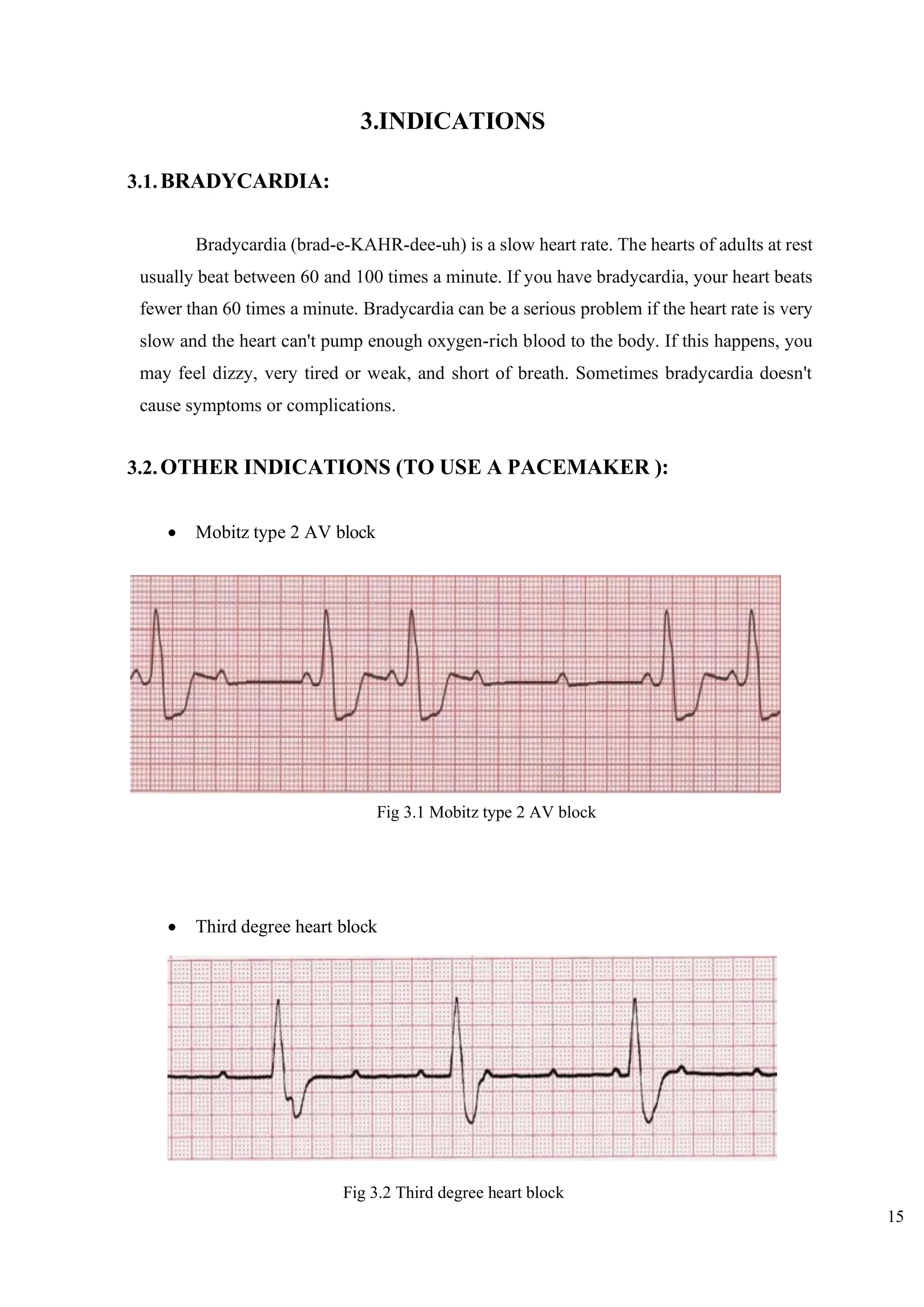 15
3.INDICATIONS
3.1.BRADYCARDIA:
Bradycardia (brad-e-KAHR-dee-uh) is a slow heart rate. The hearts of adults at rest
usually beat between 60 and 100 times a minute. If you have bradycardia, your heart beats
fewer than 60 times a minute. Bradycardia can be a serious problem if the heart rate is very
slow and the heart can't pump enough oxygen-rich blood to the body. If this happens, you
may feel dizzy, very tired or weak, and short of breath. Sometimes bradycardia doesn't
cause symptoms or complications.
3.2.OTHER INDICATIONS (TO USE A PACEMAKER ):
• Mobitz type 2 AV block
• Third degree heart block
Fig 3.1 Mobitz type 2 AV block
Fig 3.2 Third degree heart block
 