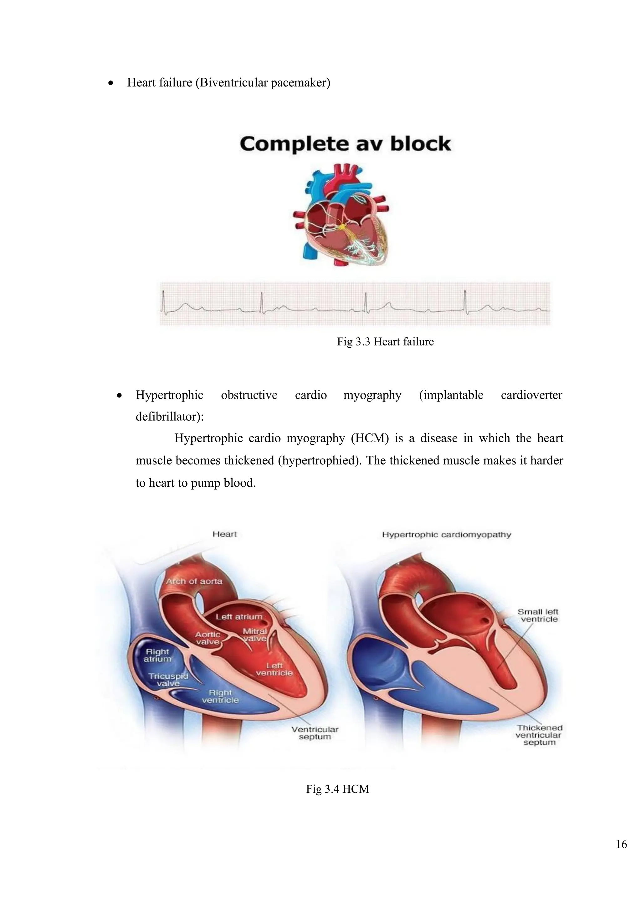 16
• Heart failure (Biventricular pacemaker)
Fig 3.3 Heart failure
• Hypertrophic obstructive cardio myography (implantable cardioverter
defibrillator):
Hypertrophic cardio myography (HCM) is a disease in which the heart
muscle becomes thickened (hypertrophied). The thickened muscle makes it harder
to heart to pump blood.
Fig 3.4 HCM
 