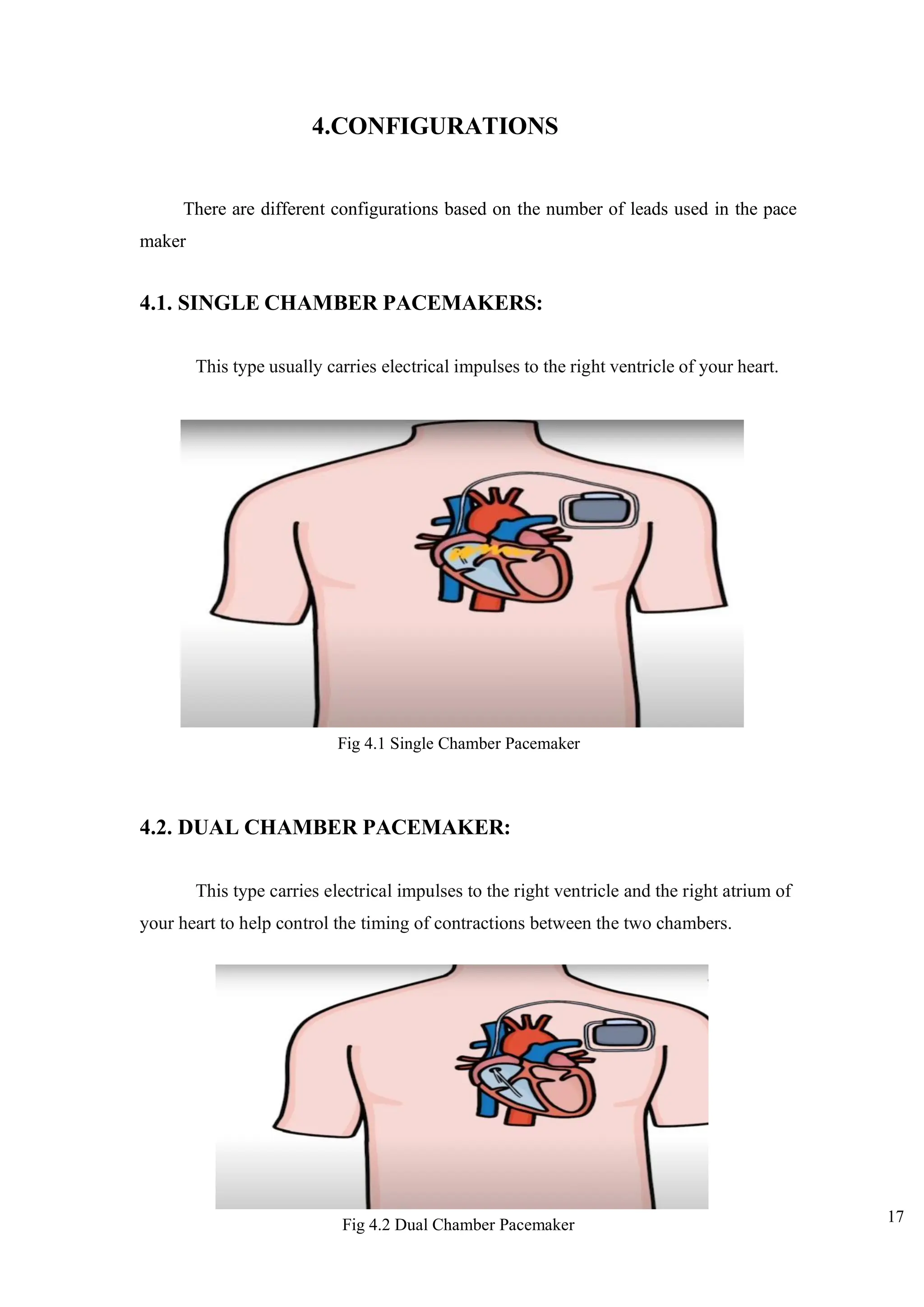 17
4.CONFIGURATIONS
There are different configurations based on the number of leads used in the pace
maker
4.1. SINGLE CHAMBER PACEMAKERS:
This type usually carries electrical impulses to the right ventricle of your heart.
4.2. DUAL CHAMBER PACEMAKER:
This type carries electrical impulses to the right ventricle and the right atrium of
your heart to help control the timing of contractions between the two chambers.
Fig 4.1 Single Chamber Pacemaker
Fig 4.2 Dual Chamber Pacemaker
 