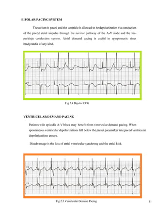 11
BIPOLAR PACING SYSTEM
The atrium is paced and the ventricle is allowed to be depolarization via conduction
of the paced atrial impulse through the normal pathway of the A-V node and the his-
purkinje conduction system. Atrial demand pacing is useful in symptomatic sinus
bradycardia of any kind.
VENTRICULAR DEMAND PACING
Patients with episodic A-V block may benefit from ventricular demand pacing. When
spontaneous ventricular depolarizations fall below the preset pacemaker rate,paced ventricular
depolarizations ensure.
Disadvantage is the loss of atrial ventricular synchrony and the atrial kick.
Fig 2.4 Bipolar ECG
Fig 2.5 Ventricular Demand Pacing
 