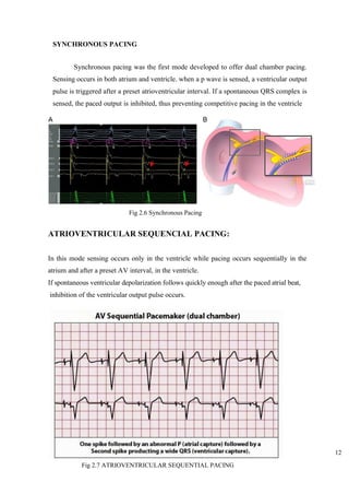 12
SYNCHRONOUS PACING
Synchronous pacing was the first mode developed to offer dual chamber pacing.
Sensing occurs in both atrium and ventricle. when a p wave is sensed, a ventricular output
pulse is triggered after a preset atrioventricular interval. If a spontaneous QRS complex is
sensed, the paced output is inhibited, thus preventing competitive pacing in the ventricle
ATRIOVENTRICULAR SEQUENCIAL PACING:
In this mode sensing occurs only in the ventricle while pacing occurs sequentially in the
atrium and after a preset AV interval, in the ventricle.
If spontaneous ventricular depolarization follows quickly enough after the paced atrial beat,
inhibition of the ventricular output pulse occurs.
Fig 2.6 Synchronous Pacing
Fig 2.7 ATRIOVENTRICULAR SEQUENTIAL PACING
 