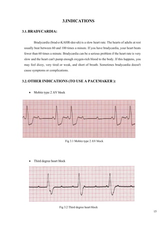 15
3.INDICATIONS
3.1.BRADYCARDIA:
Bradycardia (brad-e-KAHR-dee-uh) is a slow heart rate. The hearts of adults at rest
usually beat between 60 and 100 times a minute. If you have bradycardia, your heart beats
fewer than 60 times a minute. Bradycardia can be a serious problem if the heart rate is very
slow and the heart can't pump enough oxygen-rich blood to the body. If this happens, you
may feel dizzy, very tired or weak, and short of breath. Sometimes bradycardia doesn't
cause symptoms or complications.
3.2.OTHER INDICATIONS (TO USE A PACEMAKER ):
• Mobitz type 2 AV block
• Third degree heart block
Fig 3.1 Mobitz type 2 AV block
Fig 3.2 Third degree heart block
 
