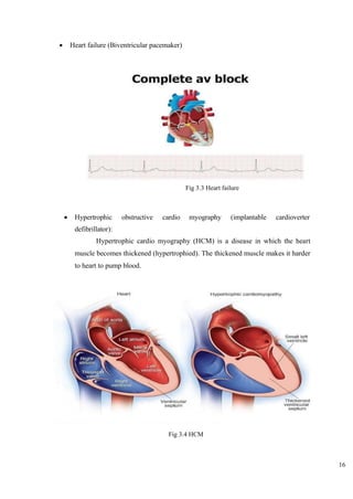 16
• Heart failure (Biventricular pacemaker)
Fig 3.3 Heart failure
• Hypertrophic obstructive cardio myography (implantable cardioverter
defibrillator):
Hypertrophic cardio myography (HCM) is a disease in which the heart
muscle becomes thickened (hypertrophied). The thickened muscle makes it harder
to heart to pump blood.
Fig 3.4 HCM
 