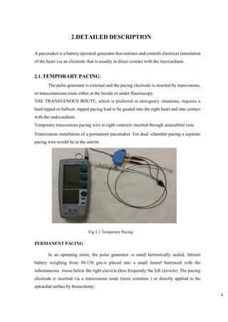 8
9
2.DETAILED DESCRIPTION
A pacemaker is a battery operated generator that initiates and controls electrical stimulation
of the heart via an electrode that is usually in direct contact with the myocardium.
2.1.TEMPORARY PACING:
The pulse generator is external and the pacing electrode is inserted by transvenous,
or transcutaneous route either at the beside or under fluoroscopy.
THE TRANSVENOUS ROUTE, which is preferred in emergency situations, requires a
hard tipped or balloon -tipped pacing lead to be guided into the right heart and into contact
with the endocardium.
Temporary transvenous pacing wire in right ventricle inserted through antecubital vein.
Transvenous installation of a permanent pacemaker. For dual -chamber pacing a separate
pacing wire would be in the antrim.
PERMANENT PACING
In an operating room, the pulse generator -a small hermetically sealed, lithium
battery weighing from 30-130 gm-is placed into a small tunnel burrowed with the
subcutaneous tissue below the right clavicle (less frequently the left clavicle). The pacing
electrode is inserted via a transvenous route (most common ) or directly applied to the
epicardial surface by thoracotomy.
Fig 2.1 Temporary Pacing
 