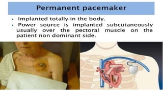 artificial Pacemaker | PPTX