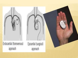 Pesmaker Pacemaker Implant | PPTX
