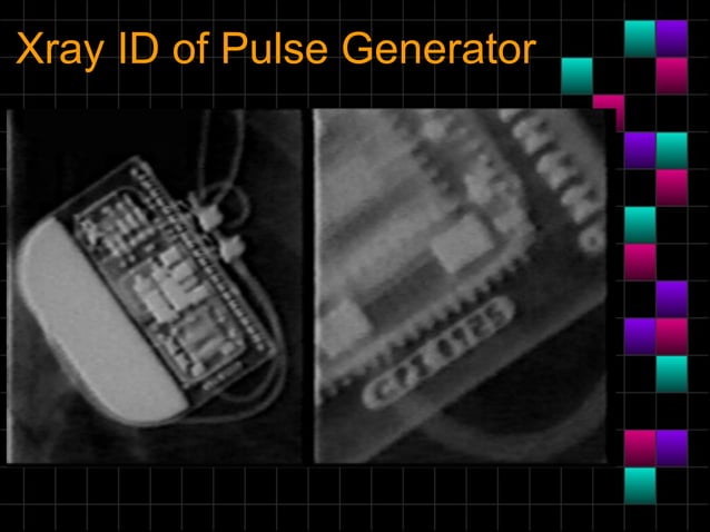 Pacemaker radiologyanintroduction | PPT