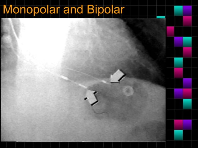 Pacemaker radiologyanintroduction | PPT