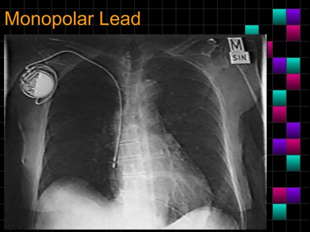 Pacemaker radiologyanintroduction | PPT